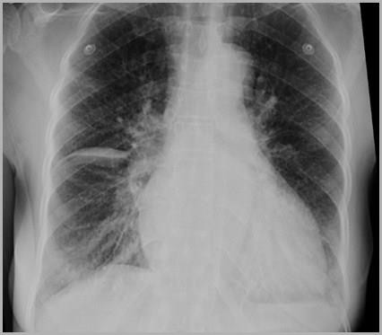 Kết quả hình ảnh cho pleural effusion horizontal fissure