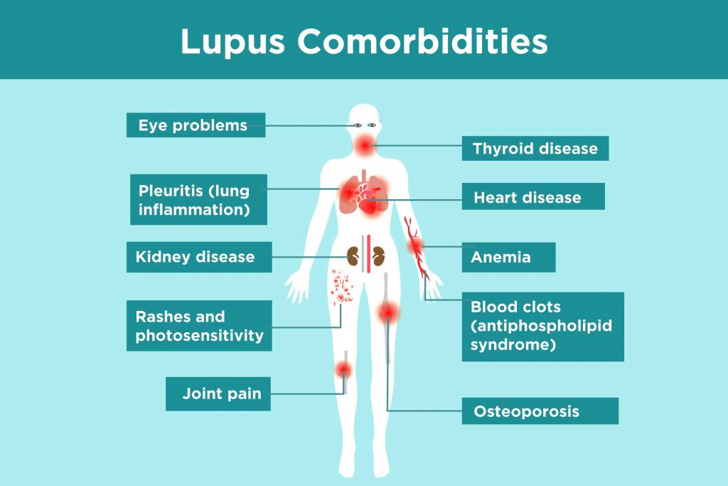 Những điều cần biết về lupus ban đỏ hệ thống