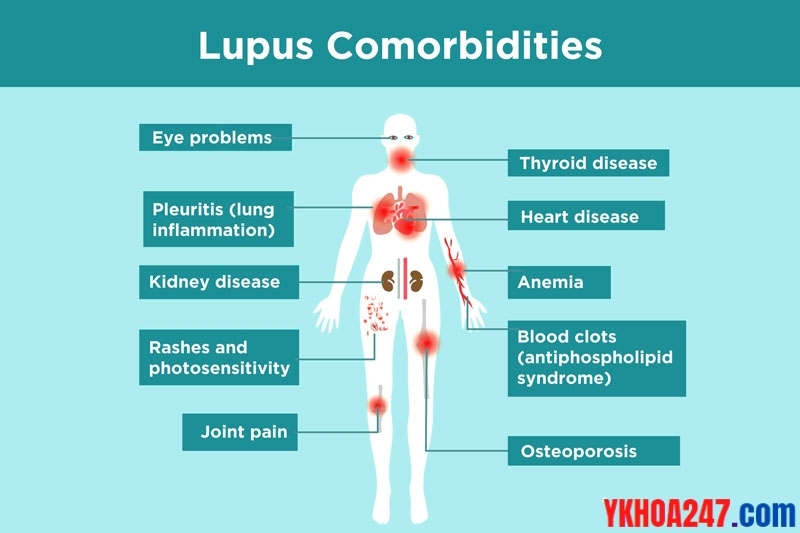 lupus