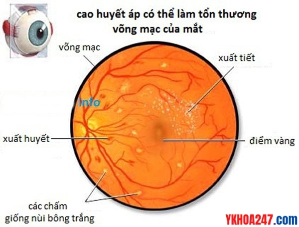 benh_vong_mac_do_tha