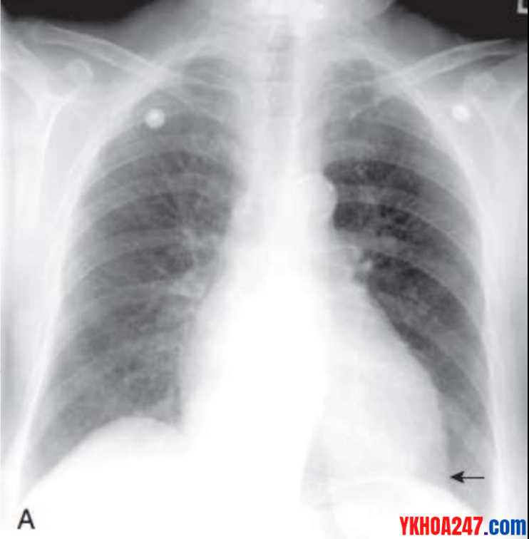 Bóng-tim-lớn-trong-suy-tim-trái