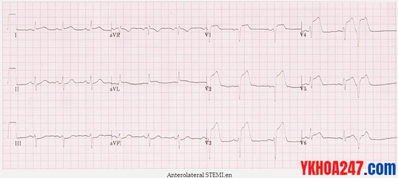 ecg nmct 2