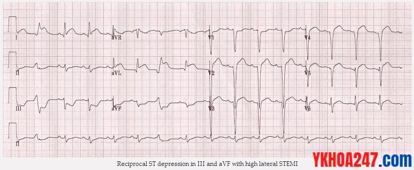 ecg nmct 5