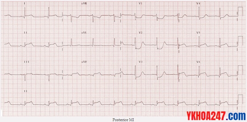 ecg nmct