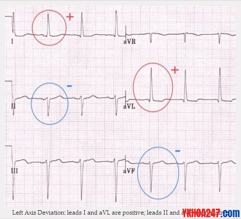 ecg suy tim 2