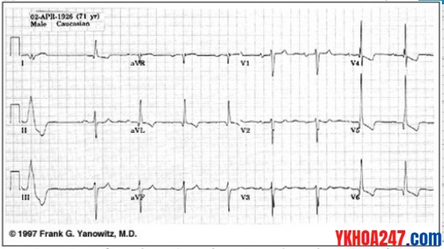 ecg suy tim