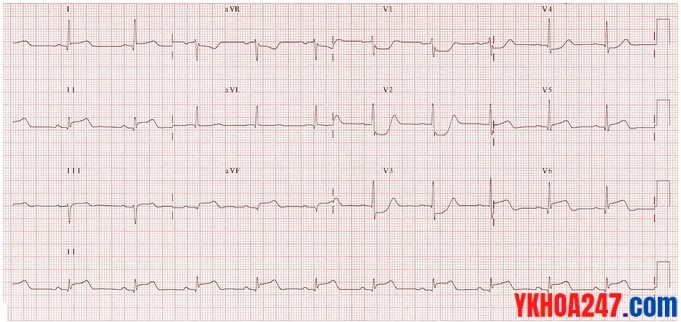 stemi