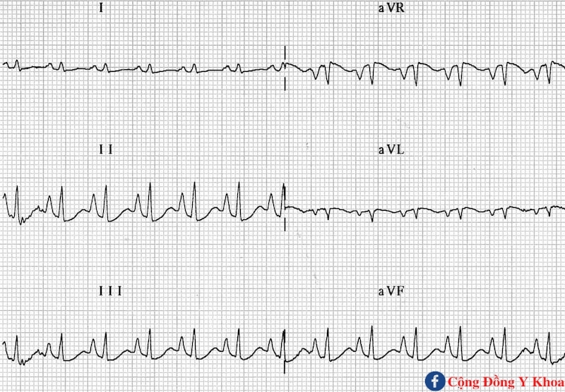 ECG Peaked P waves P pulmonale RAH